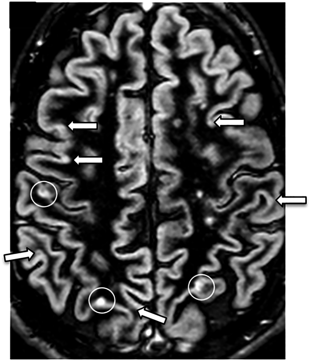 Risonanza magnetica di un cervello con lesioni da sclerosi multipla